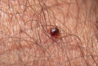 Insect bites Pharmacy first