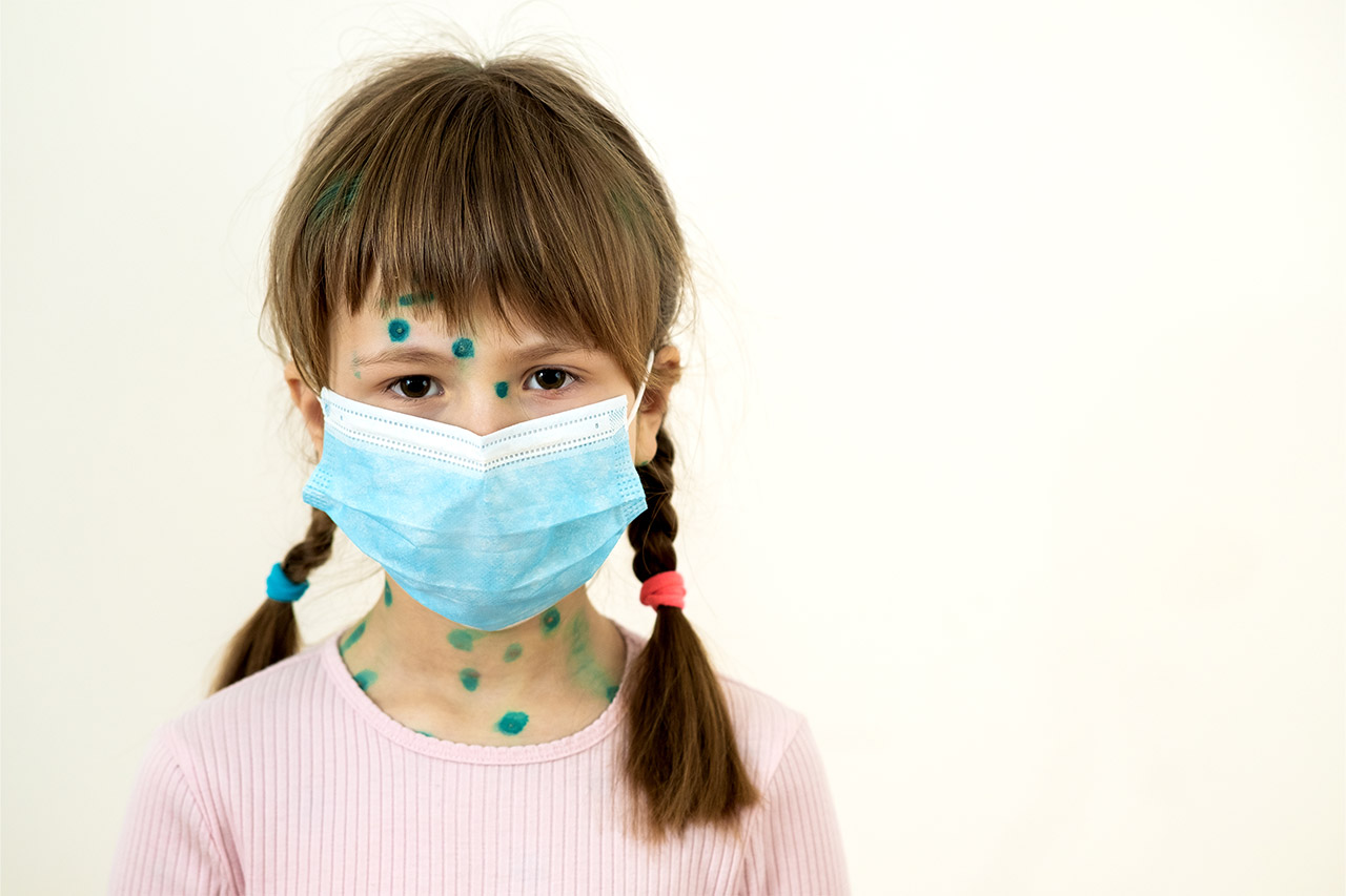 Chickenpox Vaccination Manchester